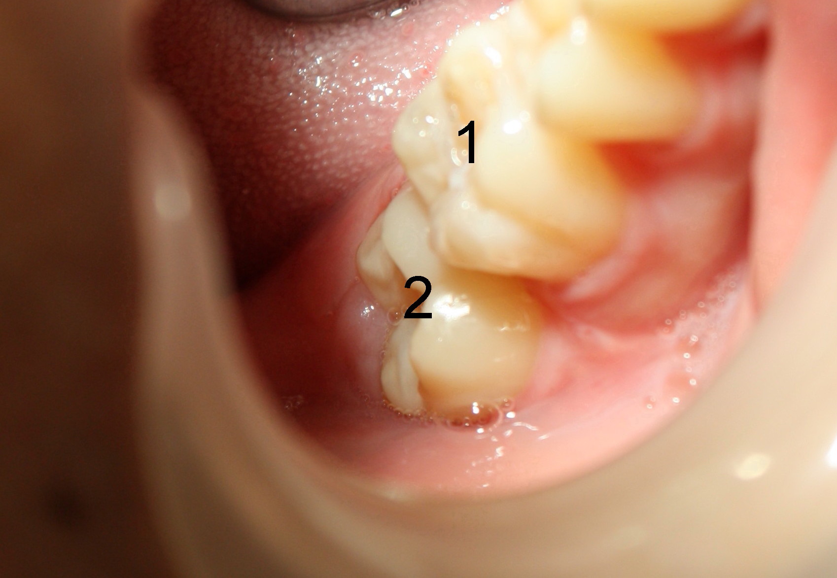 Dentigerous cyst